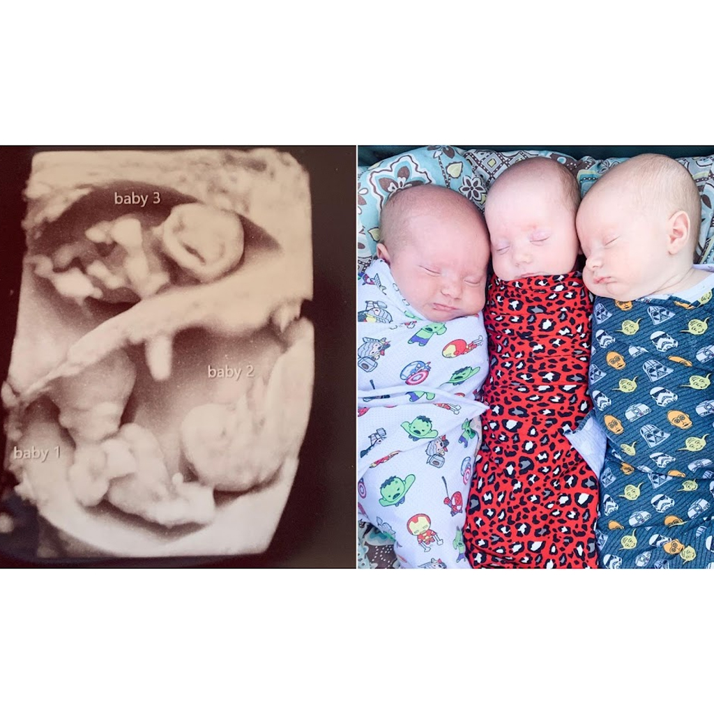 Mother of Triplets Posts Incredible Before-And-After Pregnancy Photographs