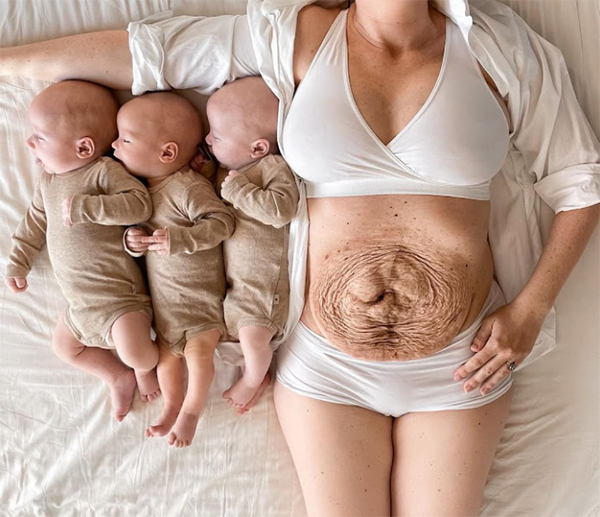 Mum of Triplets Shows off Her Pre and Post-birth Belly