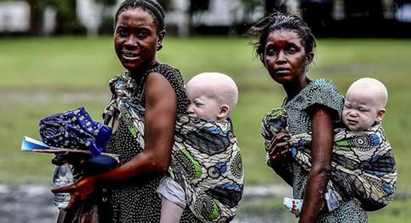 Rare Albino Twins With Snow-White Hair Were Born to a Mother