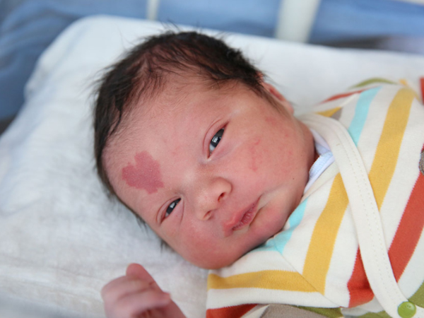 A Cute Baby Boy Was Born With A Birthmark In The Form Of A Heart.