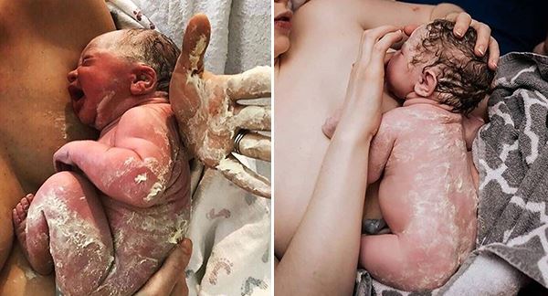 These photographs depict newborns with fetal sebum