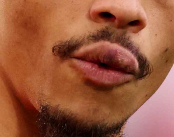 Ex-Man City Leroy Sane shows off busted lip for first time after being punched by Bayern Munich team-mate Sadio Mane