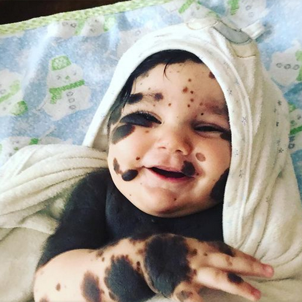 Parents refuse to give up their newborn son with 80% birthmarks, born like a panda.