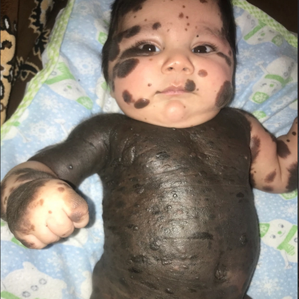 Parents refuse to give up their newborn son with 80% birthmarks, born like a panda.