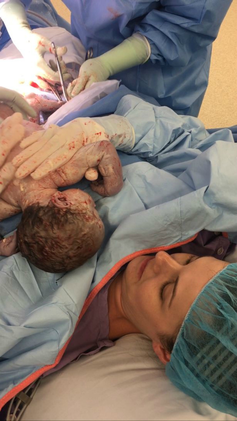 Mother assists in the Caesarean section delivery of her own child.